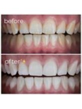 エクシアホワイトニング 津駅前店/お客様ビフォーアフター