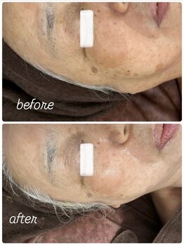 イロドリ(IRODORI)/REVIハーブピーリング