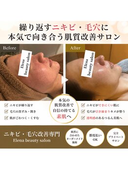 エレナ(Elena)の写真/ニキビケア・毛穴ケアに特化しているハーブピーリングです。県内からもご来店頂いております!