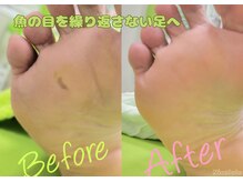 ニコルル 大阪天満店(Nicolulu)/痛い魚の目ビフォーアフター