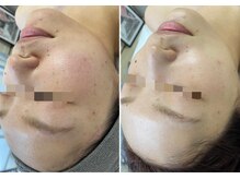 アヌエヌエ(aNueNue)/ブライダルにも◎美白！