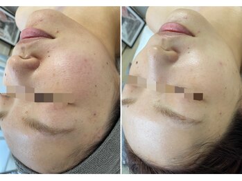 アヌエヌエ(aNueNue)/ブライダルにも◎美白！