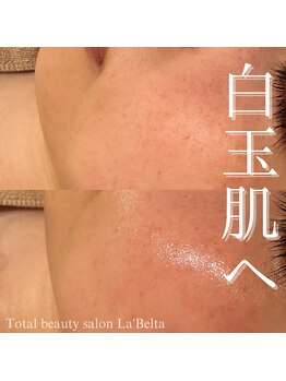 エステティックサロン ラ ベルタ(Esthetic Salon La Belta)/エクソソームコース（1回）