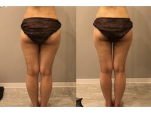 プシュケ(PSYCHE)/悩める下半身太りに♪