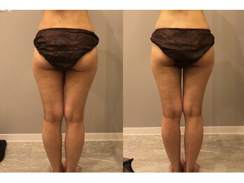 プシュケ(PSYCHE)/悩める下半身太りに♪