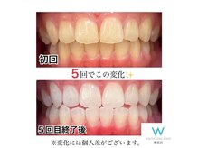 ５回でこのホワイトニング効果！お得に通えるクーポンあり♪