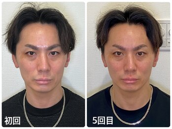 KTYフェイスジム 名古屋栄店(KTY FACE GYM)/1ヶ月での変化