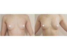 ラーナ(Lana)/【バストアップ】症例♪