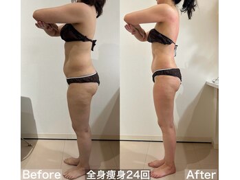 ヴィクシア(VIXIA)/痩身90分