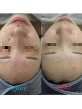 ファーファラ(Farfalla)/ハーブピーリング