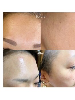 顔脱毛がしたい