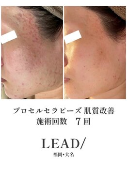 リードスラッシュ(LEAD/)/