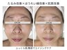【しわ・クマ・ハリ・艶★】生幹細胞導入!水光エアジェットフェイシャル♪