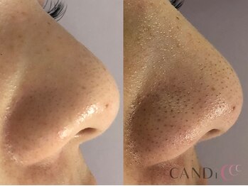 キャンディ 岐阜(CANDi)/ハイドラピーリング/黒ずみ毛穴