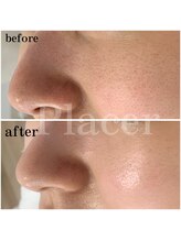 プラセル(Placer)/どんなお肌になりたいですか？