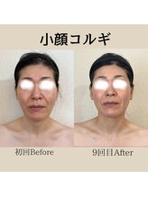 リーブル(LIBRE)/小顔コルギ＆ボディ　9回