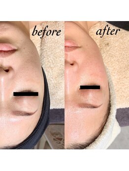 リュクス Luxe+tkm 南船場/ハーブピーリング