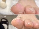 【フット】巻き爪補正　夏に◎