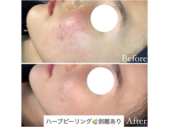 マドモアゼル 麻布十番/ハーブピーリング