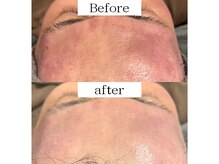 ソナミオール(SonaMior)/メンズOKハーブピーリングサロン