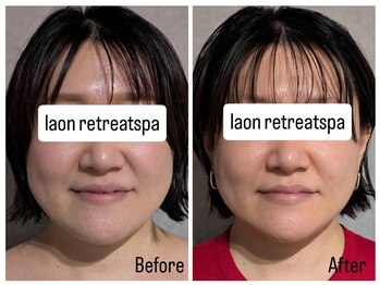 ラオン(laon)/リフトアップ石膏パック