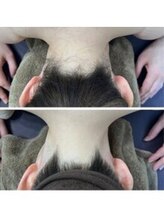 ミース 自由が丘店/うなじ矯正◆ビフォーアフター