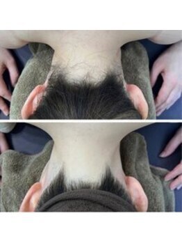 ミース 自由が丘店/うなじ矯正◆ビフォーアフター