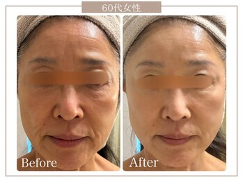 ロイヤル(ROYAL)の写真/40代からのたるみ・ほうれい線改善|再生美容で引き上げる本格肌管理ケア◎