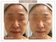 ロイヤル(ROYAL)の写真/40代からのたるみ・ほうれい線改善|再生美容で引き上げる本格肌管理ケア◎