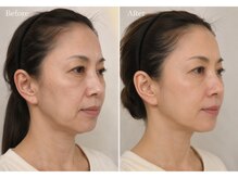 オニュ(ONYU)の雰囲気（リフトアップで若見え&老け顔卒業★［北九州/八幡西区］）