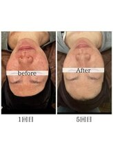 プリズム/光フェイシャルビフォーアフター