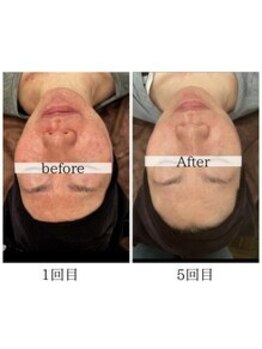 プリズム/光フェイシャルビフォーアフター