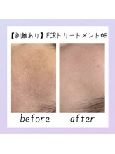 シャルム ココ 八尾店(Charme coco)/肌質改善(ツヤ) １回目