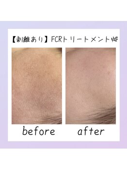 シャルム ココ 八尾店(Charme coco)/肌質改善(ツヤ) １回目