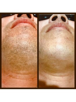 リアンジュ/ヒゲ脱毛の経過