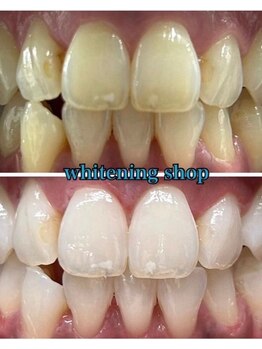 ホワイトニングショップ 恵比寿店/フリーパス終了のお客様