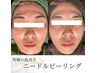 毛穴/ニキビケア/しわ改善◎高濃度VAマイクロニードルピーリング/初回9000円