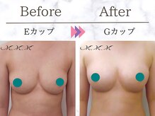 メディカルサロン エム エム エム 心斎橋本店(M.M.M)/【バストアップ例】　E→Gカップ