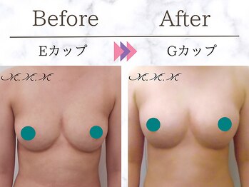メディカルサロン エム エム エム 心斎橋本店(M.M.M)/【バストアップ例】　E→Gカップ