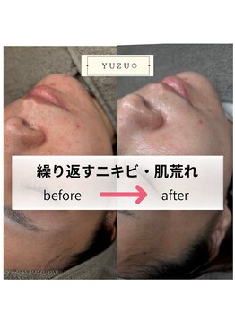 ユズドット(yuzu.)/大人気のエステ版ダーマ