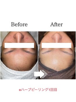 グラシア(gracia)/シミ・毛穴ケア専門店gracia