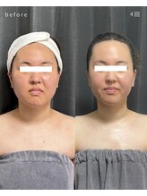 レクシア(LEXIA)/小顔ケア症例｜PRO LIFT 4回目