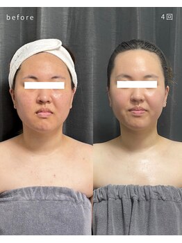 レクシア(LEXIA)/小顔ケア症例｜PRO LIFT 4回目