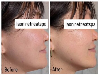 ラオン(laon)/リフトアップ石膏パック