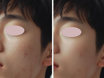 バニッシュ 川口店(VANISH)/光フェイシャルで肌悩みを解決！