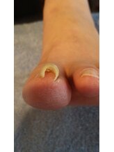 フットケアサロン ラビフット(Rabbi foot)/巻き爪ケアはツメフラで
