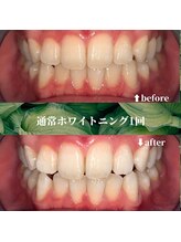 フタバ 天神大名店(futaba)/初回ホワイトニングbefore after