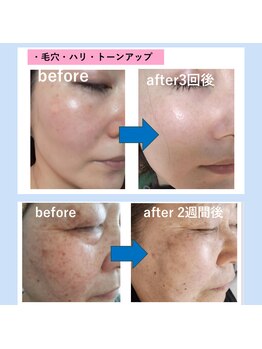 ミアローザ(Mia Rosa)/光フェイシャルの効果