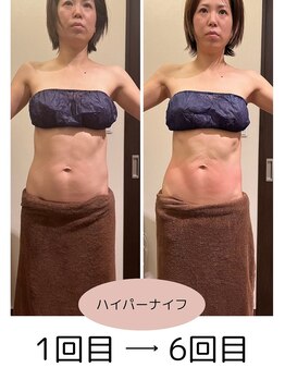 若松整体院 太白区院/ハイパーナイフ！