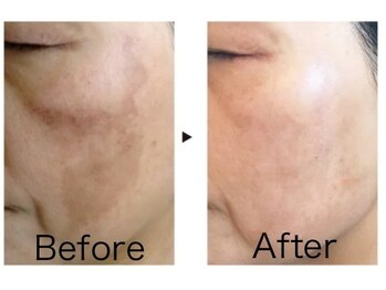 デアルーチェ(DEA LUCE)/シミ改善ピーリングフェイシャル